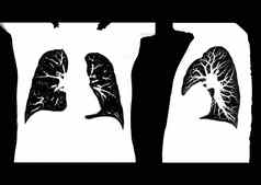 扫描胸部肺放射学部门医院科维德扫描身体x光测试检测科维德病毒疫情传播概念