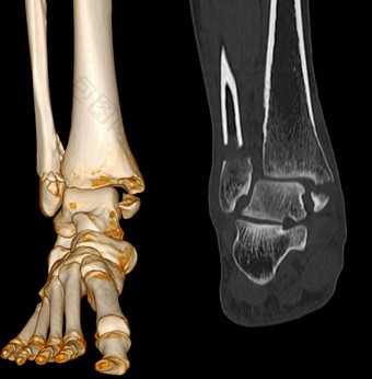 扫描脚踝脚计算断层摄影术脚踝联合脚体积呈现图像显示骨折胫骨腓骨骨