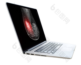 医生数字平板电脑x射线数字<strong>乳房</strong>x光检查孤立的白色背景