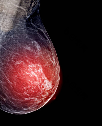 x射线数字乳房x光检查乳房x光检查一边乳房标准的观点中侧的斜蚊油的观点