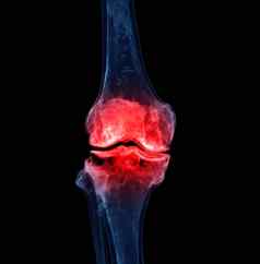 渲染膝盖联合孤立的黑色的背景显示疼痛区域