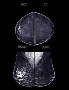 x射线数字乳房x光检查乳房x光检查一边乳房视图蚊油