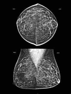 x射线数字乳房x光检查乳房x光检查一边乳房标准的观点两国身高