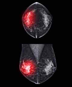 x射线数字乳房x光检查乳房x光检查一边乳房视图蚊油