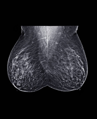 x射线数字乳房x光检查乳房x光检查一边乳房标准的观点中侧的斜蚊油的观点