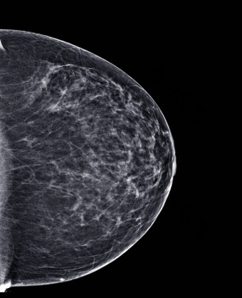 x射线数字乳房x光检查乳房x光检查一边乳房标准的观点两国身高