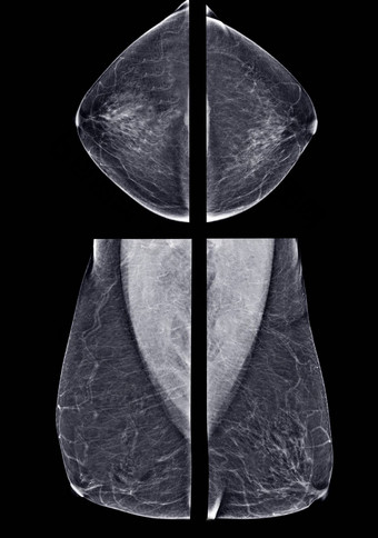 x射线数字乳房x光检查乳房x光检查一边乳房视图蚊油