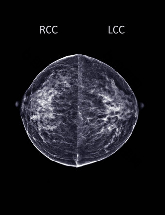 x射线数字<strong>乳房</strong>x光检查<strong>乳房</strong>x光检查一边<strong>乳房</strong>标准的观点两国身高