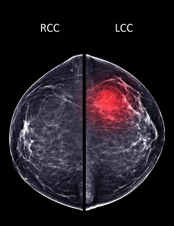 x射线数字<strong>乳房</strong>x光检查<strong>乳房</strong>x光检查一边<strong>乳房</strong>标准的观点两国身高