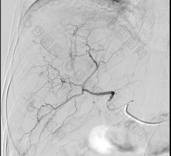 成像安静化疗栓塞术过程剂量化疗药物管理直接肝肿瘤hcc显示肝动脉