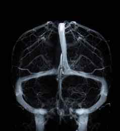 脑毒液种诊断脑静脉血栓形成