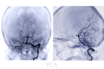 脑血管造影术图像透视干预放射学显示脑动脉