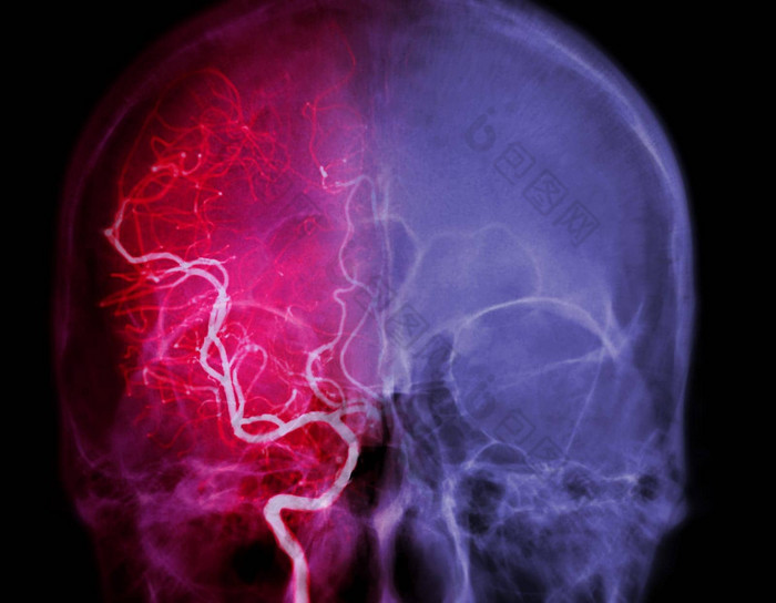脑血管造影术图像透视干预放射学显示脑动脉