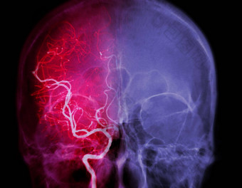 脑血管造影术图像透视干预放射学显示脑<strong>动脉</strong>