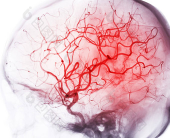 脑血管造影术图像<strong>透视</strong>干预放射学显示脑动脉