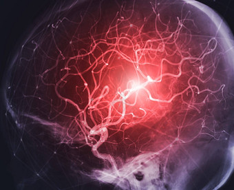 脑血管造影术图像<strong>透视</strong>干预放射学显示脑动脉