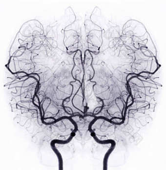 脑血管造影术图像透视干预放射学显示脑动脉