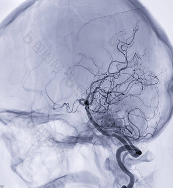 脑血管造影术成像器更加强大脑动脉透视干预放射学显示脑动脉