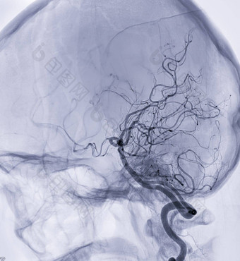 脑血管<strong>造影</strong>术成像器更加强大脑<strong>动脉</strong>透视干预放射学显示脑<strong>动脉</strong>