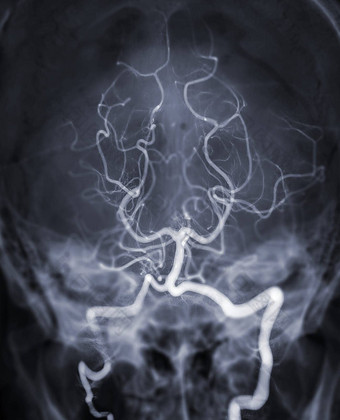 脑血管造影术成像器更加强大脑动脉透视干预放射学显示基部的动脉