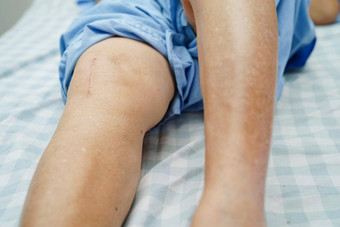 亚洲上了年纪的女人病人疤痕膝盖<strong>更换</strong>手术医院