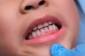 <strong>特写</strong>镜头内部口服腔健康的孩子美丽的行婴儿牙齿年轻的女孩打开口揭示上较低的牙齿硬口感软口感牙科口服健康检查