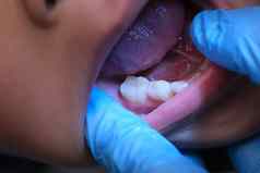 特写镜头内部口服腔健康的孩子美丽的行婴儿牙齿年轻的女孩打开口揭示上较低的牙齿硬口感软口感牙科口服健康检查