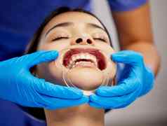 脸颊牵开器使真正的区别年轻的女人牙科过程执行