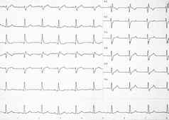 心率纸记录心电图预防心疾病心电图条心脏心律失常改变心跳代表纸复制空间