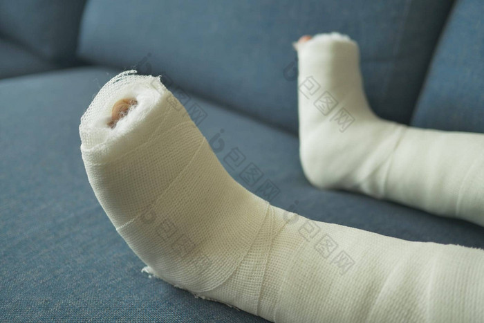 孩子石膏绷带腿