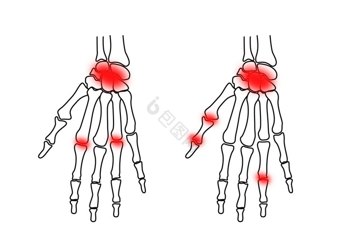 手骨骨骼关节炎图片