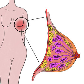 乳腺疾病乳腺增生