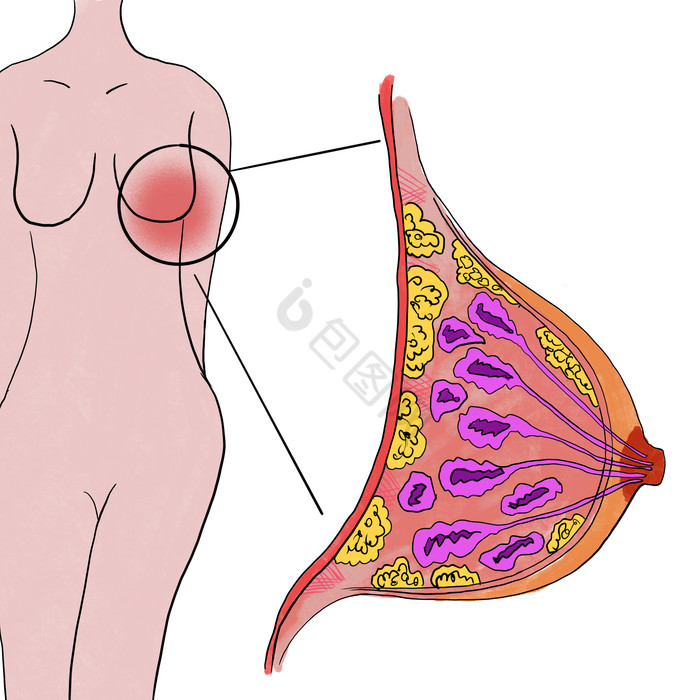 乳腺疾病乳腺增生图片