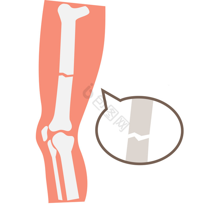 人体骨骼骨头骨折图片