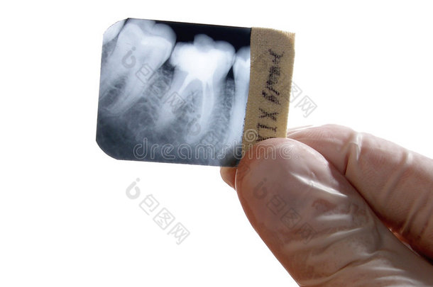 x射线牙齿诊断