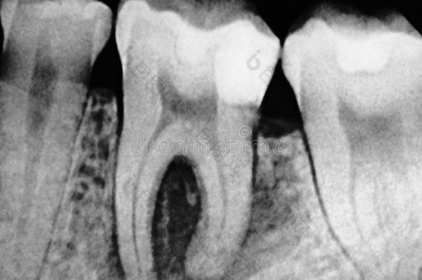 牙科磨牙x射线
