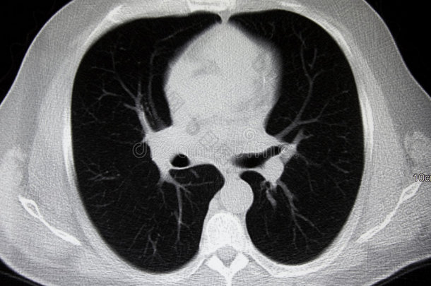 胸部放射学、msct（计算机体层摄影术）