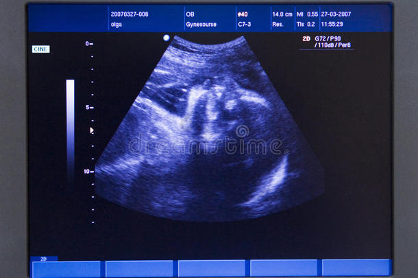 超声波在他母亲胃里制造的婴儿