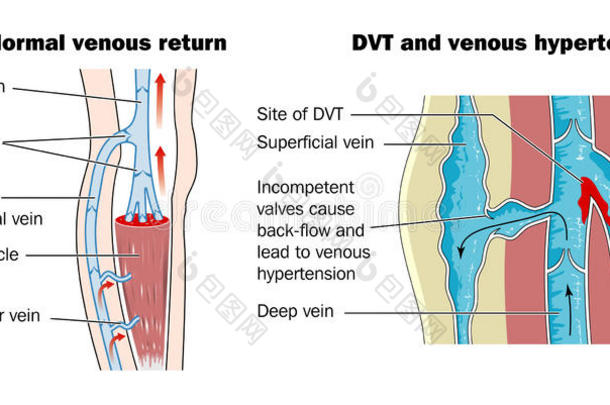 深静脉血栓形成