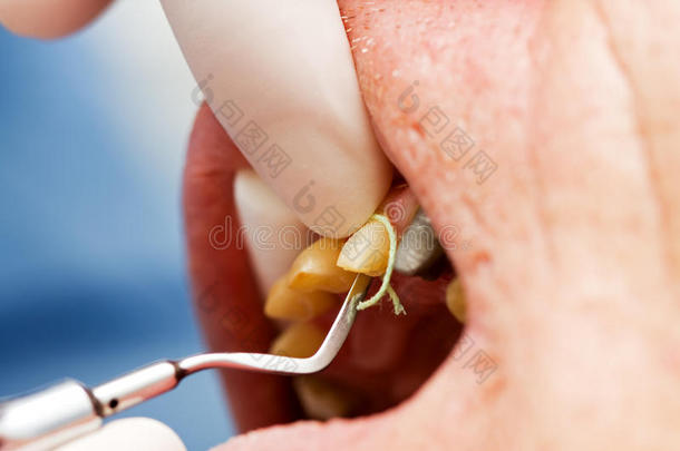 牙龈沟内放置牙线