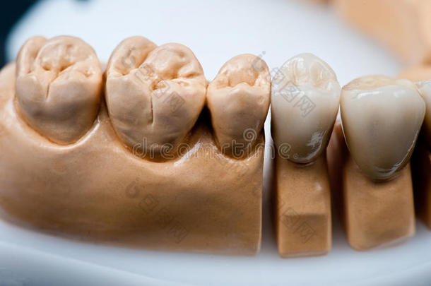 牙齿修复模型