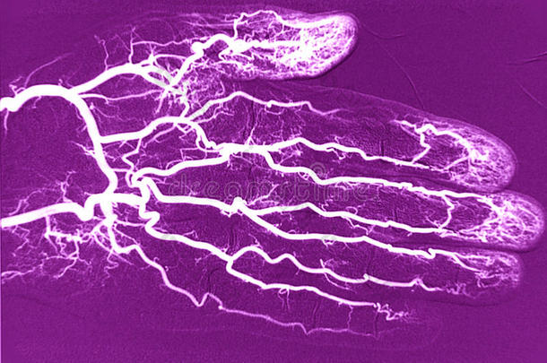 手血管、血管造影、动脉造影