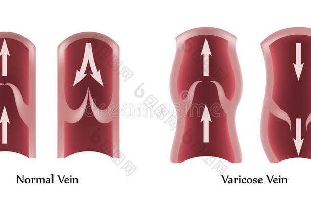 静脉曲张和正常静脉