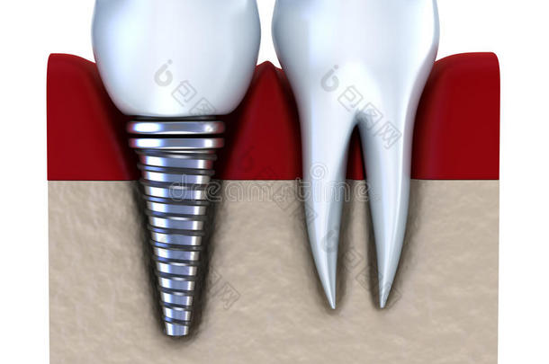 牙种植体-植入颌骨