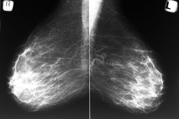 乳房X光片