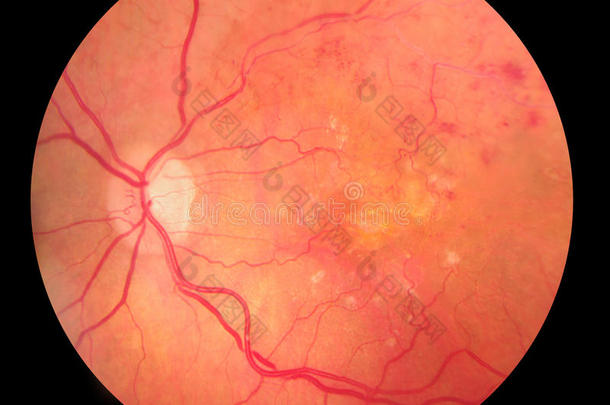 视网膜病变出血眼底医学照片