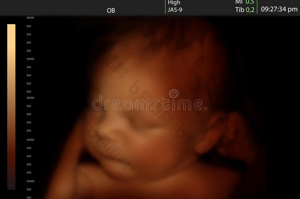 新生儿三维超声图像