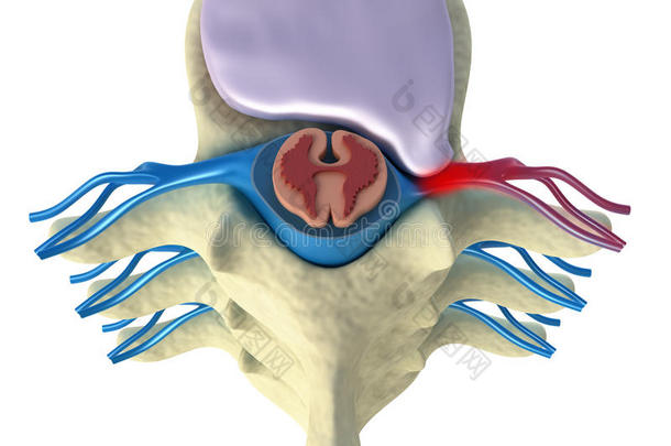 <strong>椎间盘</strong>突出