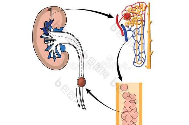<strong>肾结石</strong>形成