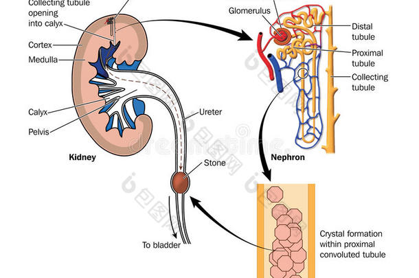 <strong>肾结石</strong>形成